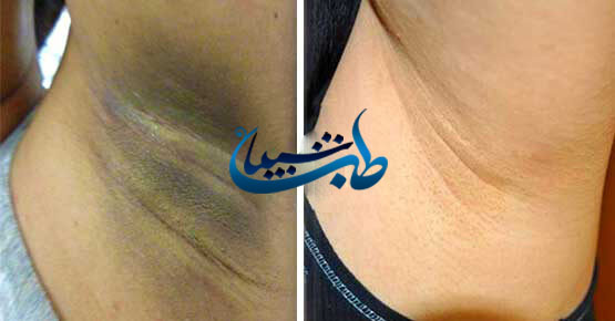 عکس کرم زیر بغل سکرت