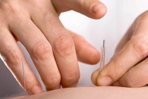 طب سوزنی: هنر باستانی شفابخشی